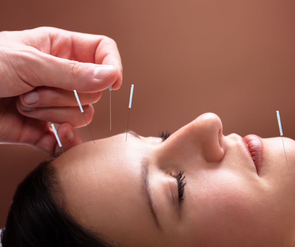 Acupuncture to Sinuses